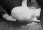 Một bé trong ca song sinh chào đời còn nguyên trong bọc ối