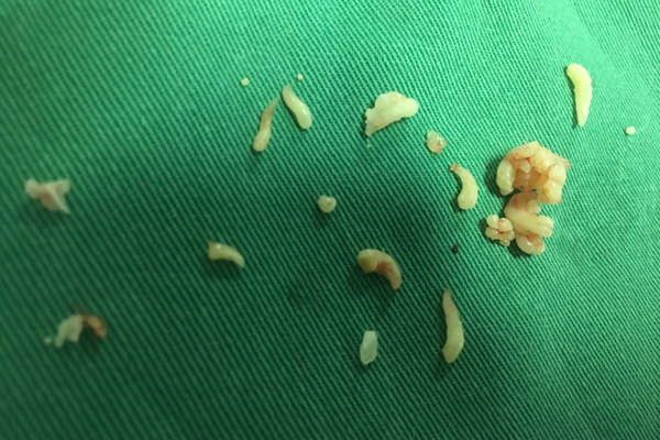 Gắp 20 chiếc răng trong khối u của bé gái 12 tuổi