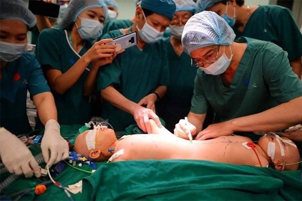 Ê-kíp phẫu thuật cho hai bé Trúc Nhi - Diệu Nhi lập kỷ lục Việt Nam