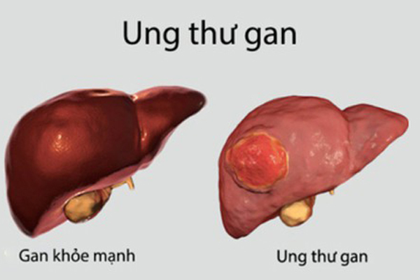 Thanh niên Hà Nội 20 tuổi mắc ung thư gan, bệnh ủ từ lâu không biết