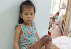 Bàn chân trụi lủi của bé gái 7 tuổi sau 18 lần phẫu thuật đau đớn