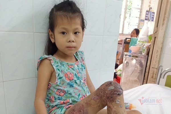 Bàn chân trụi lủi của bé gái 7 tuổi sau 18 lần phẫu thuật đau đớn