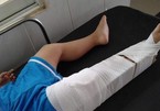 Cô giáo ở Đồng Nai làm gãy chân trẻ mầm non 3 tuổi