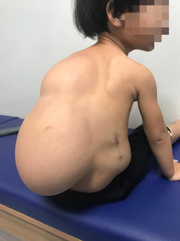 Bé gái 2 tuổi oằn mình cõng khối u lớn sau lưng, cột sống biến dạng