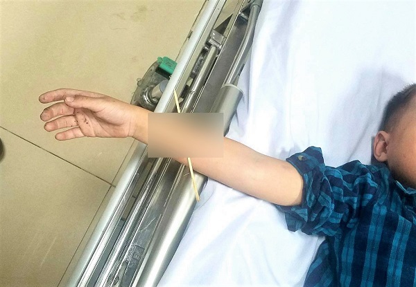 Bé trai 6 tuổi bị que xiên thịt nướng đâm xuyên cánh tay