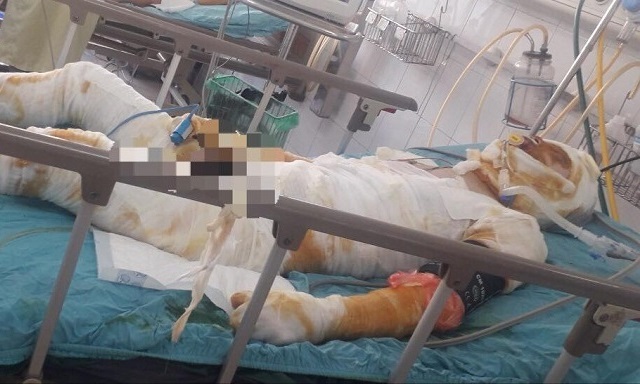Cha bỏng nặng 99% nguy kịch, con thơ ngơ ngác đợi chờ