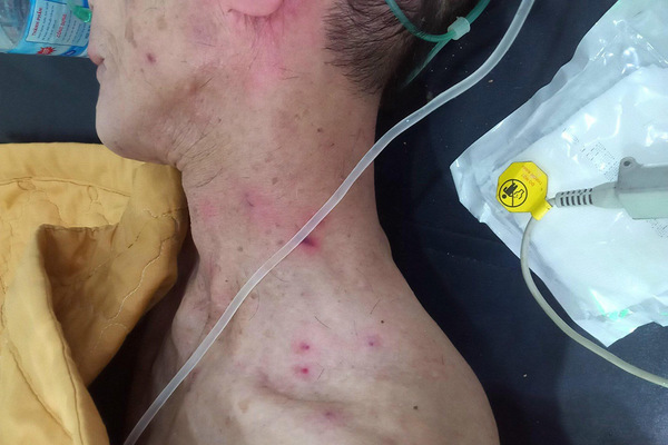 Hai cha con bị ong đốt hàng trăm nốt