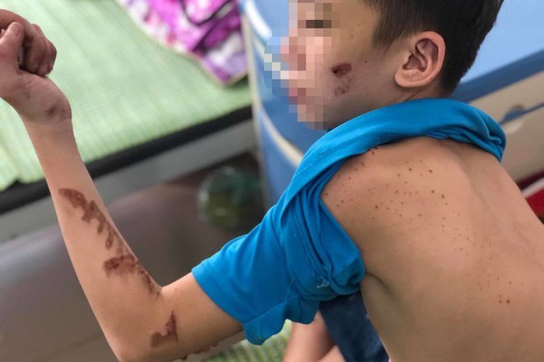 Lưng lỗ chỗ vết thương từ dụng cụ cạo vảy cá của nhân viên quán bánh xèo