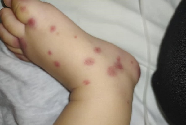 Tưởng vết ban đơn thuần, ai ngờ mắc bệnh cực hiếm Việt Nam chưa ghi nhận