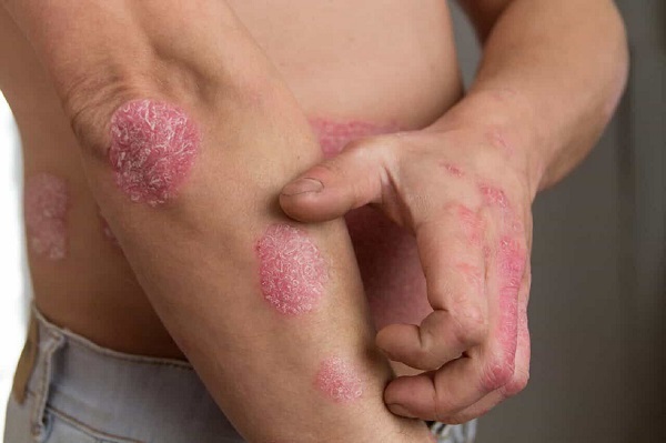 Sau cú sốc tình cảm, nam thanh niên nổi mảng đỏ bong tróc khắp người
