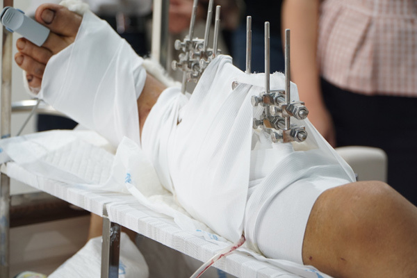 Nối liền chân cho người đàn ông bị kẻ lạ xông vào nhà chém
