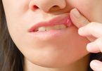 Vết loét miệng hay bị bỏ qua có thể là dấu hiệu của ung thư