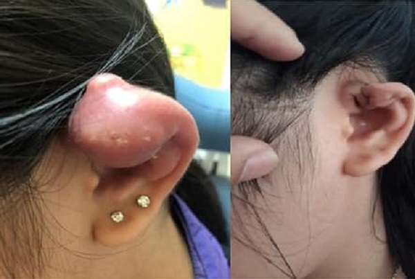 Tai mưng mủ, phù nề nặng sau khi xỏ khuyên