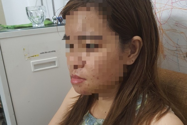 Người phụ nữ bị đánh hội đồng gãy quai hàm ngay tại nhà ở Bình Dương