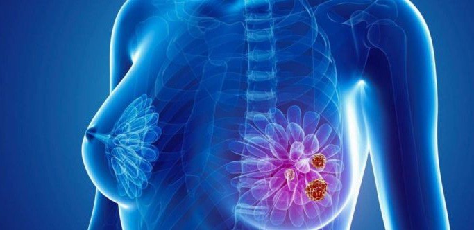 Nền tảng công nghệ mới giúp cải thiện chẩn đoán ung thư vú tại Việt Nam
