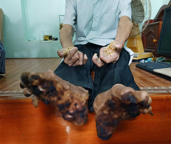 Căn bệnh tay chân hóa thành gỗ từng xuất hiện ở Việt Nam
