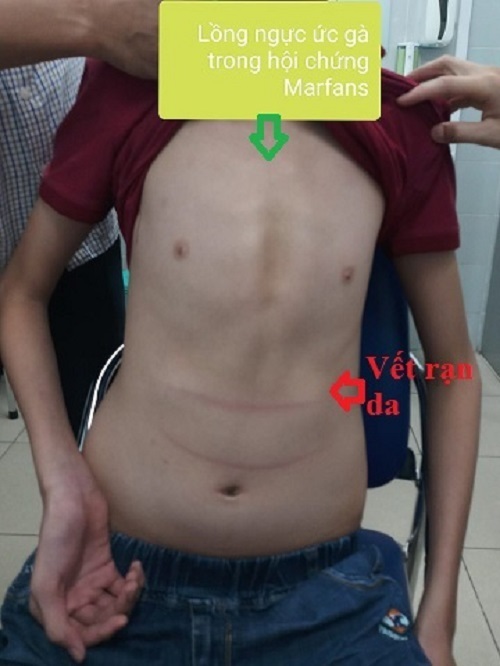 Finger length in Marfan syndrome - Mayo Clinic