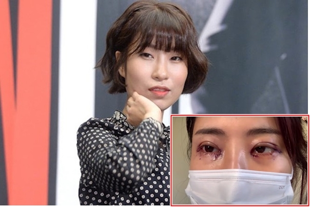 Diễn viên hài Hàn Quốc 31 tuổi 'dao kéo' thay đổi diện mạo
