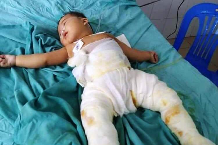 Ngã vào chậu than, bé gái bị cháy đen chân, tính mạng nguy hiểm