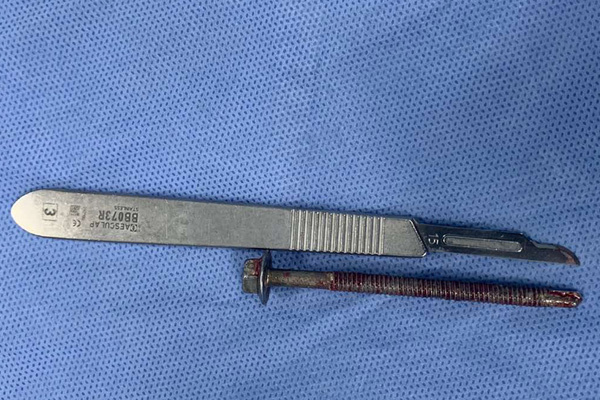 Uống rượu say, người đàn ông bị nhét ốc vít dài 6 cm vào niệu đạo