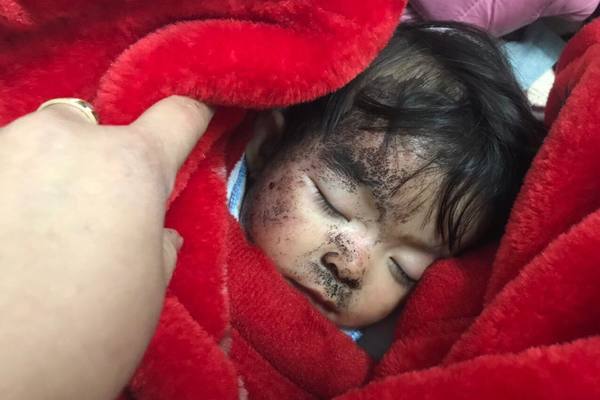 Bé gái bị bỏng nặng, cháy đen khuôn mặt rất cần được giúp đỡ - VietNamNet
