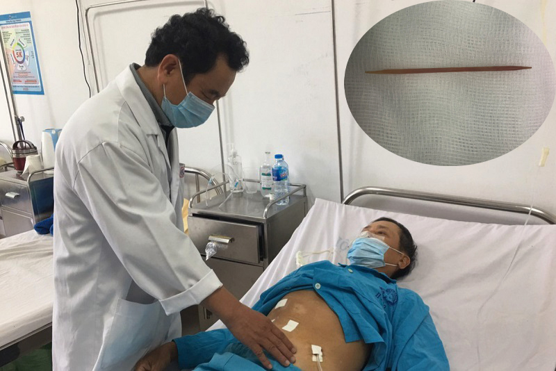 Nuốt tăm xỉa răng dài 5 cm, người đàn ông bị thủng dạ dày