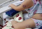 Bé 5 tuổi ở Quảng Bình nhiễm khuẩn Whitmore sau khi bị gà mổ