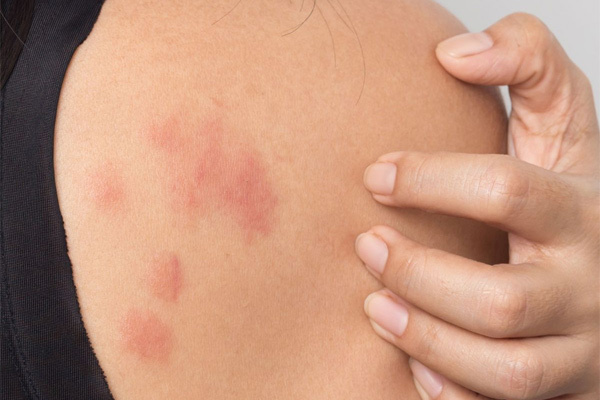 Bốn triệu chứng trên da ít người biết đến của bệnh nhân Covid-19