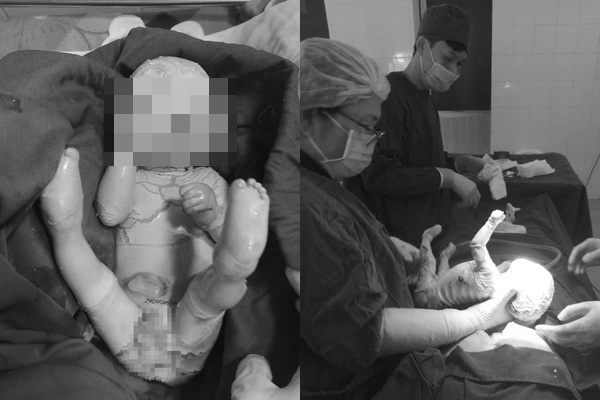 15 Year Old Woman Gives Birth To Boy With Rare Harlequin Ichthyosis Syndrome Vietnamnet