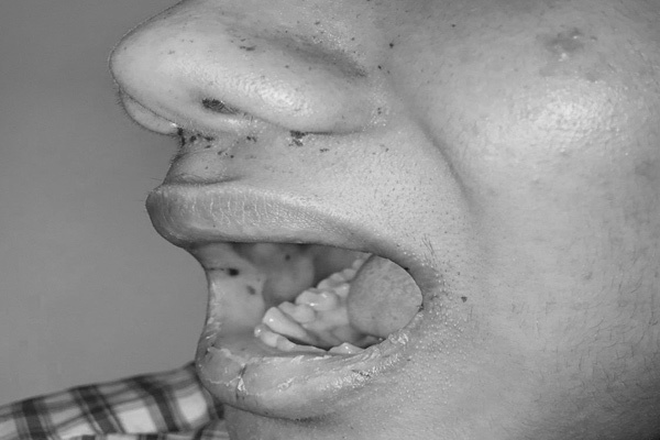 Thanh niên mọc tàn nhang quanh miệng, không ngờ mắc bệnh gây hoại tử ruột