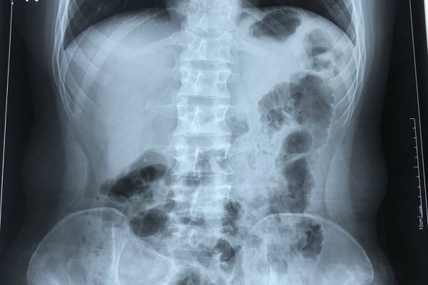 Nam thanh niên 17 tuổi có trái tim bên phải