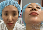 Bác sĩ cắt sụn sườn nâng mũi vẹo cho cô gái Hà Nội