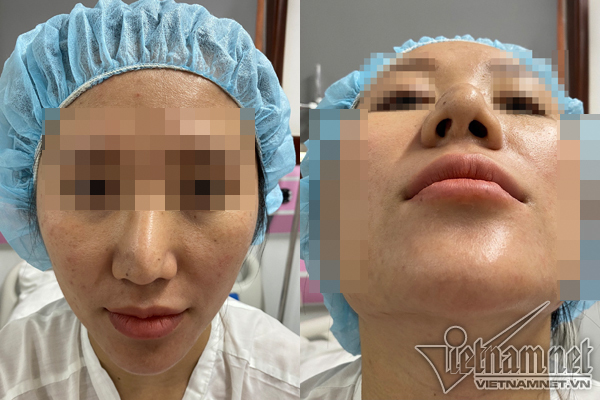 Bác sĩ cắt sụn sườn nâng mũi vẹo cho cô gái Hà Nội