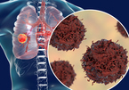 Lý do 75% ung thư phổi tại Việt Nam không phát hiện được sớm