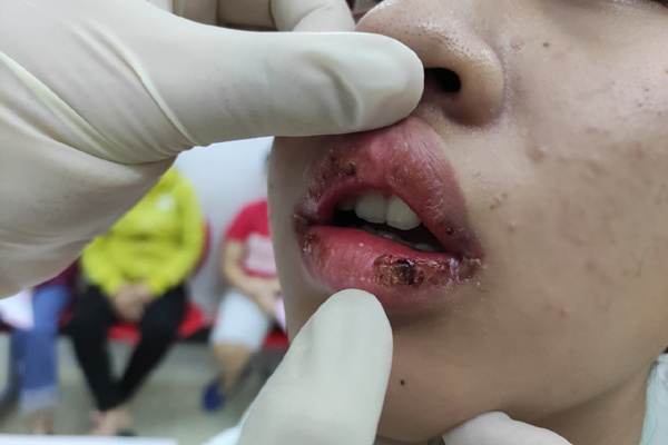 Nữ sinh rỉ máu môi vì son mua trên mạng