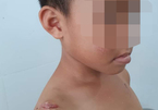 Bé trai 6 tuổi bị cha dượng bạo hành, châm thuốc lá vào người