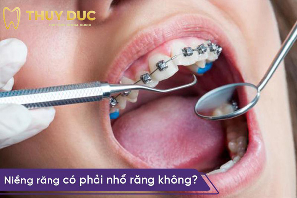 Phương pháp niềng răng không đau tại nha khoa Thúy Đức