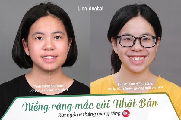 Rút ngắn 6 tháng niềng răng với công nghệ Nhật Bản | LINN DENTAL ...