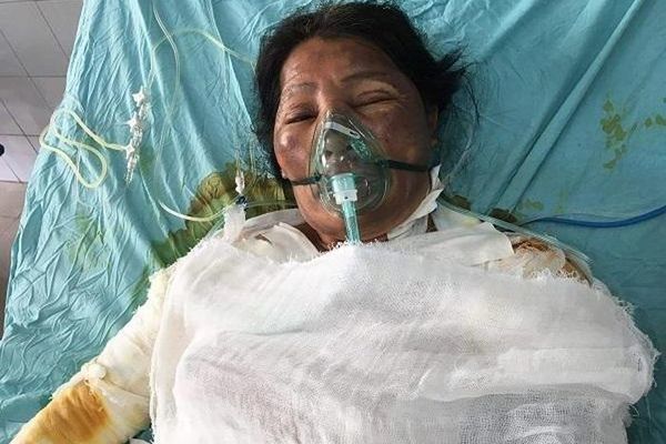 Cô Nguyễn Thị Cảnh bị bỏng lửa đã được xuất viện về nhà