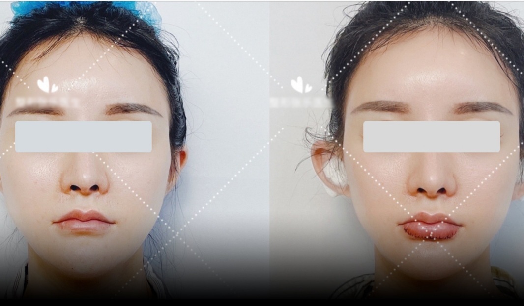 Chị em đua nhau gọt bắp chân, bất chấp rủi ro