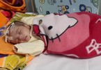 Sự sống mong manh của bé gái 5 tháng tuổi bị tắc ruột bẩm sinh