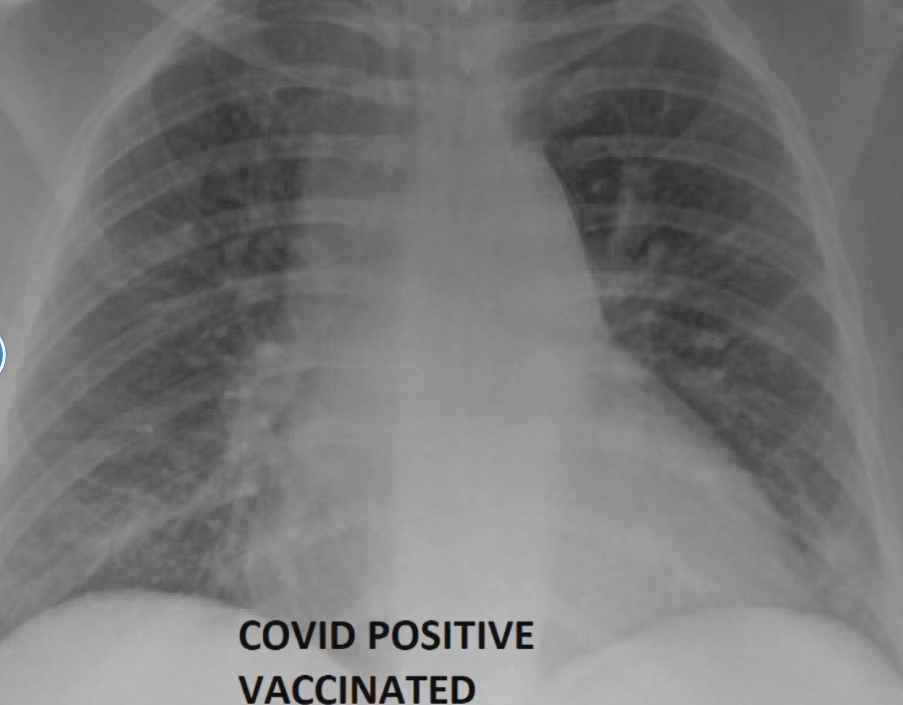 Sự khác biệt của người đã tiêm vắc xin khi nhiễm Covid-19