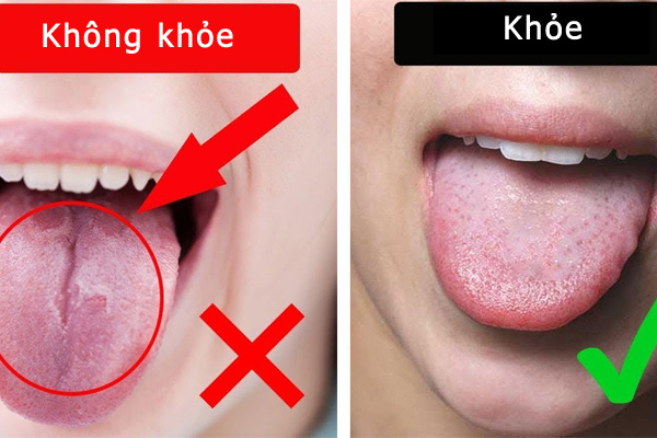 Biểu hiện ở lưỡi cảnh báo bệnh gan