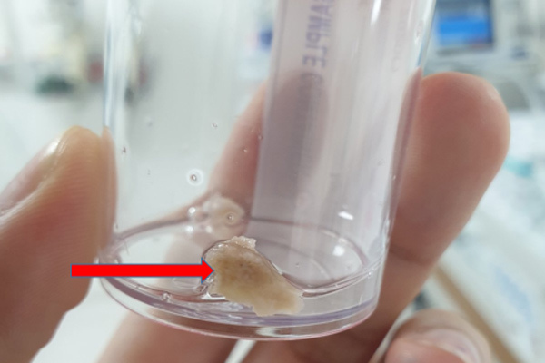 Gắp 2 mảnh xương trong phế quản bé 20 tháng tuổi