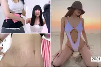 Sĩ Thanh nịt bụng 7 năm, nấm da lở loét để có vòng eo con kiến