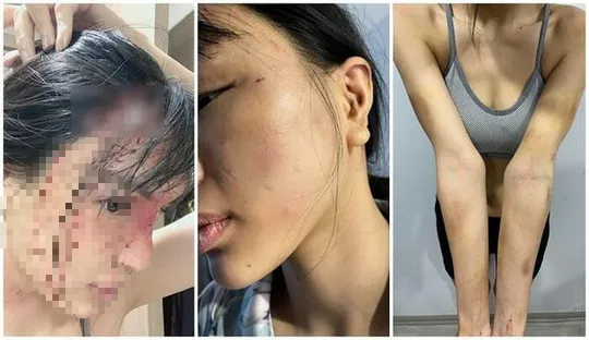 Công an vào cuộc vụ siêu mẫu Khả Trang tố bị đánh đập tàn bạo