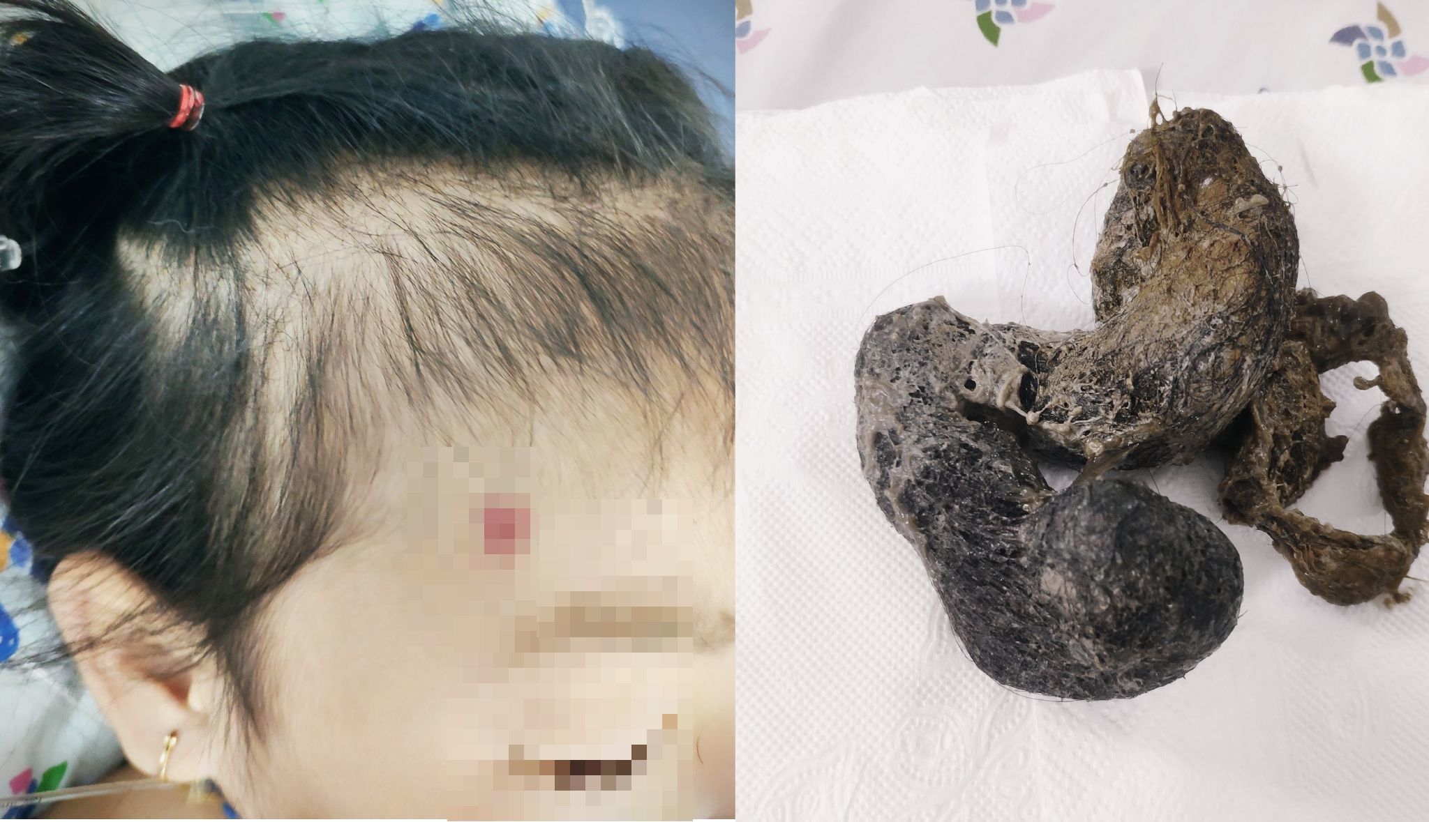Bé gái 4 tuổi cấp cứu vì hội chứng "cô bé tóc mây" hiếm gặp
