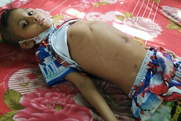 Liên tục ói ra máu, bé trai 8 tuổi bị xơ gan xin cứu gấp