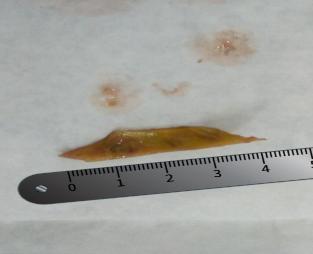 Người đàn ông ở Hà Nội nhiễm độc toàn thân sau bữa liên hoan