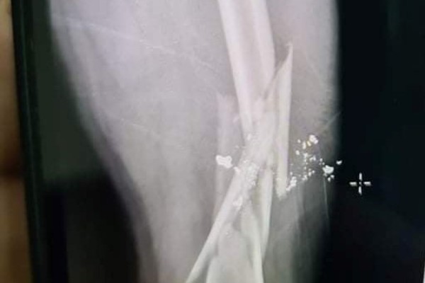 Mâu thuẫn trên bàn nhậu, người đàn ông bị bắn gãy xương đùi